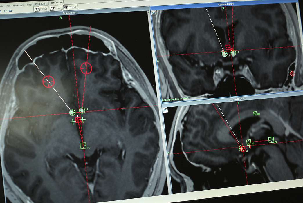 Brain temperature can be an important health indicator, but measuring it has been tricky until now. (AP Photo/Erika Kinetz)