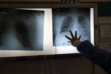 A new time-saving AI method for reading chest X-rays during intubation has life-saving potential.  Above, a doctor examines chest X-rays in an intensive care unit. (AP Photo/Rodrigo Abd)